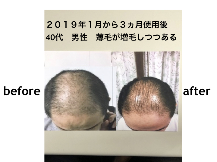育毛増毛効果
２０１９年１月から３ヵ月使用後
40代　男性　薄毛が増毛しつつある