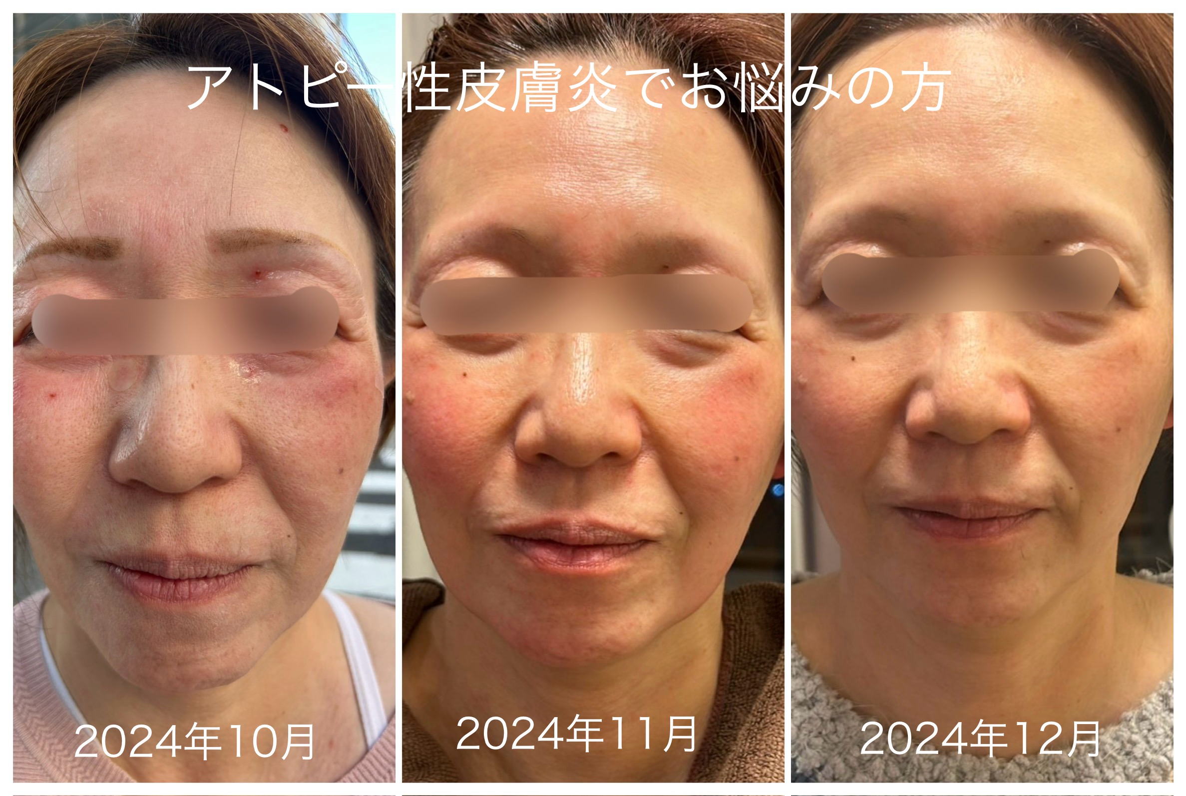 アトピー症例