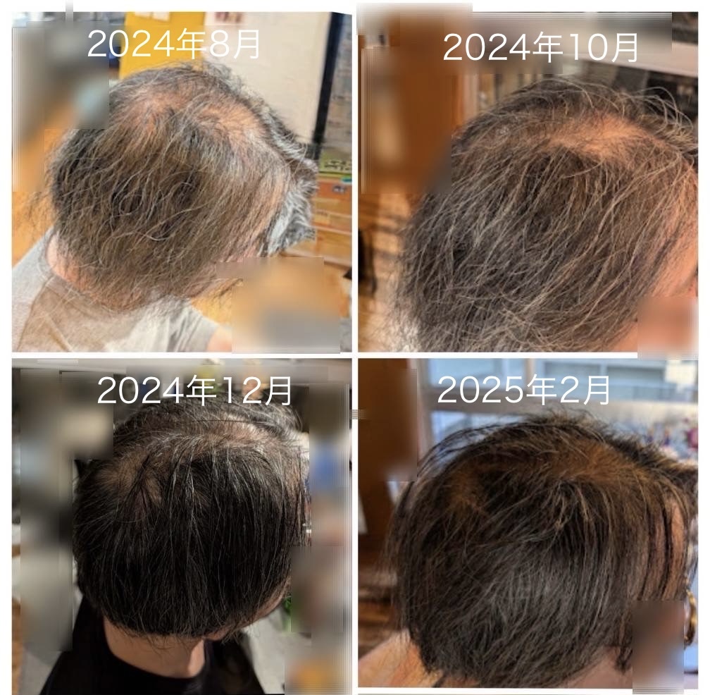 発毛症例 66歳男性